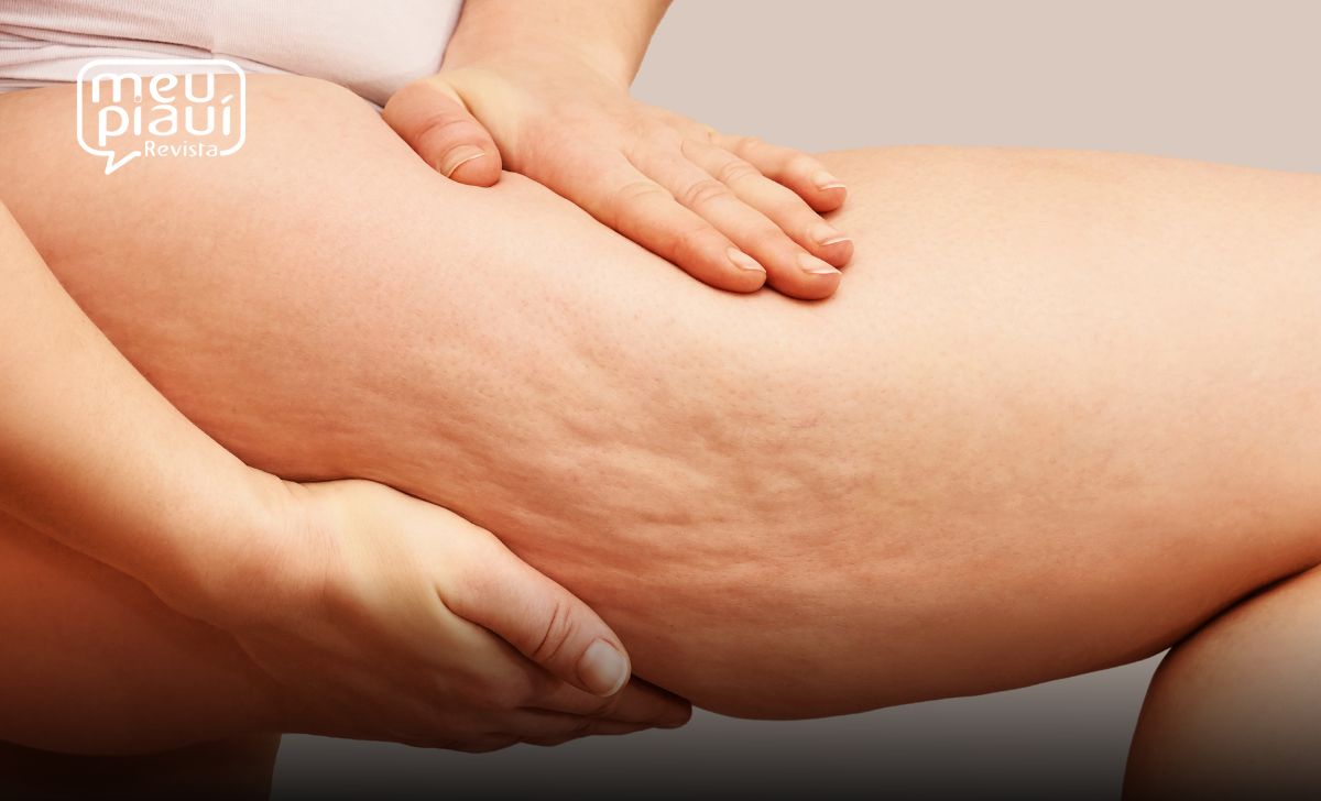 Lipedema: acúmulo desproporcional de gordura nas pernas tem